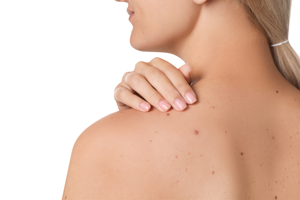 closeup of woman`s body with birthmarks on white background, bac